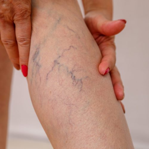 Elderly woman in white panties shows cellulite and varicose veins on a light isolated background. Concept for medicine and cosmetology.